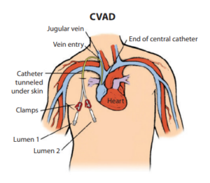 Differences Between Tunneled & Non-Tunneled Central Venous Catheters